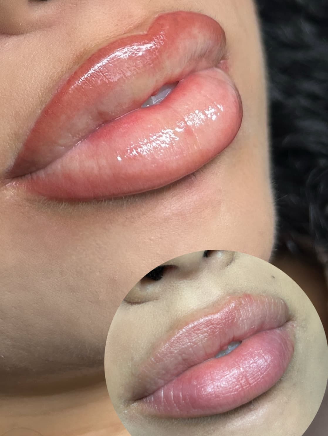 Lip filler before and after